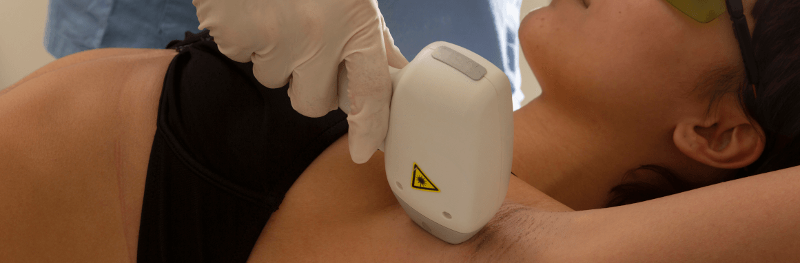 Epilazione laser: una soluzione efficace per rimuovere i peli superflui
