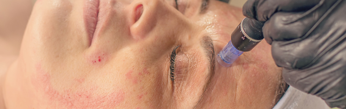 Il microneedling: efficace nella riduzione delle cicatrici