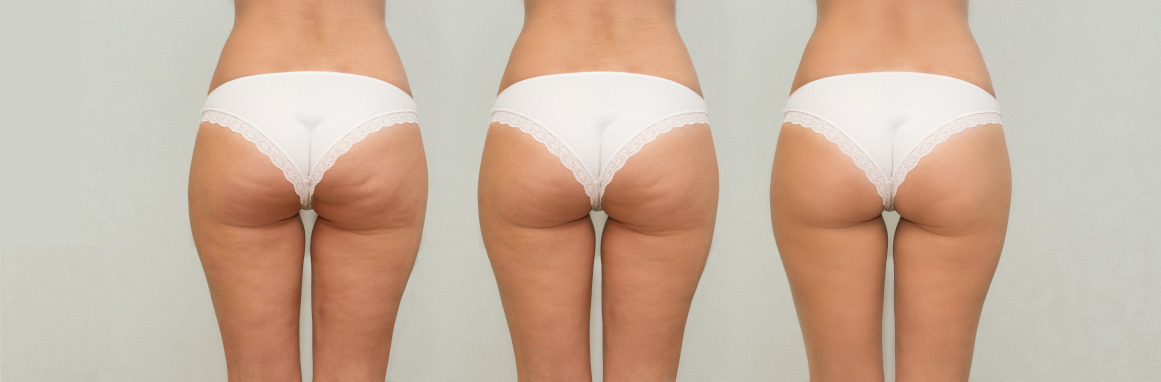 Come eliminare la cellulite: i metodi più efficaci