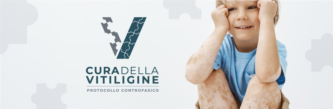 Quando la vitiligine colpisce un bambino
