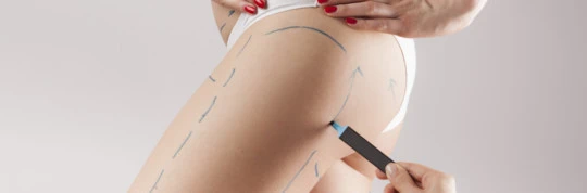 La liposcultura per rimodellare il corpo