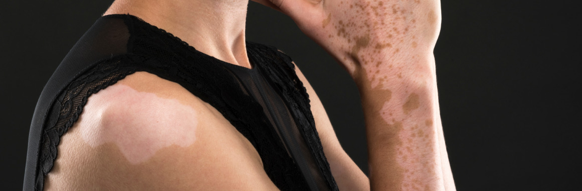 I tatuaggi e la vitiligine, facciamo chiarezza